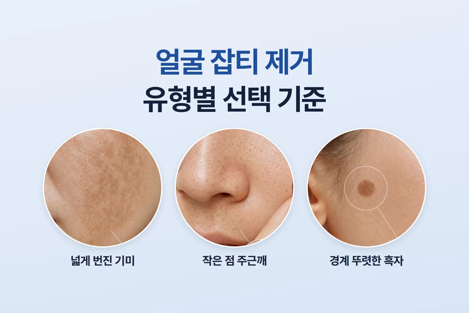 얼굴 잡티 제거 시술 종류는_잡티 유형별 선택 기준과 치료 기간