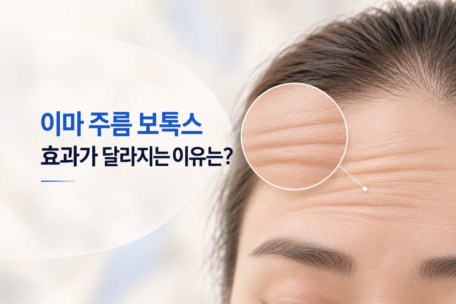 이마 주름 보톡스만으로 깊은 주름이 펴질까_효과가 달라지는 이유
