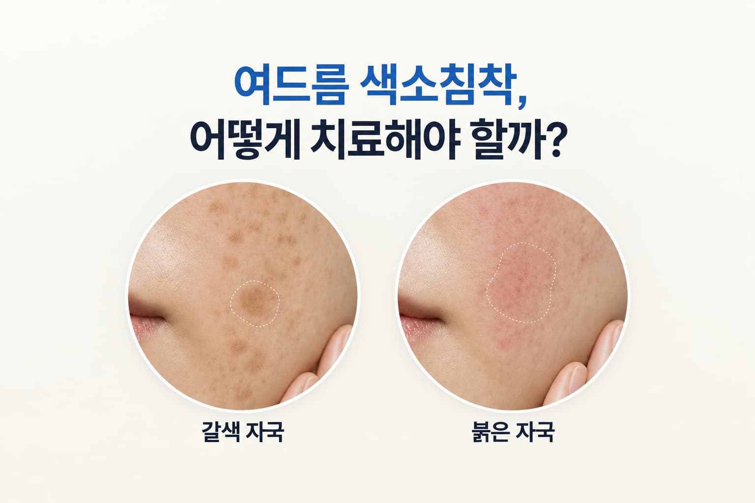 여드름 색소침착 없애는법_자국 유형별 치료 방법은
